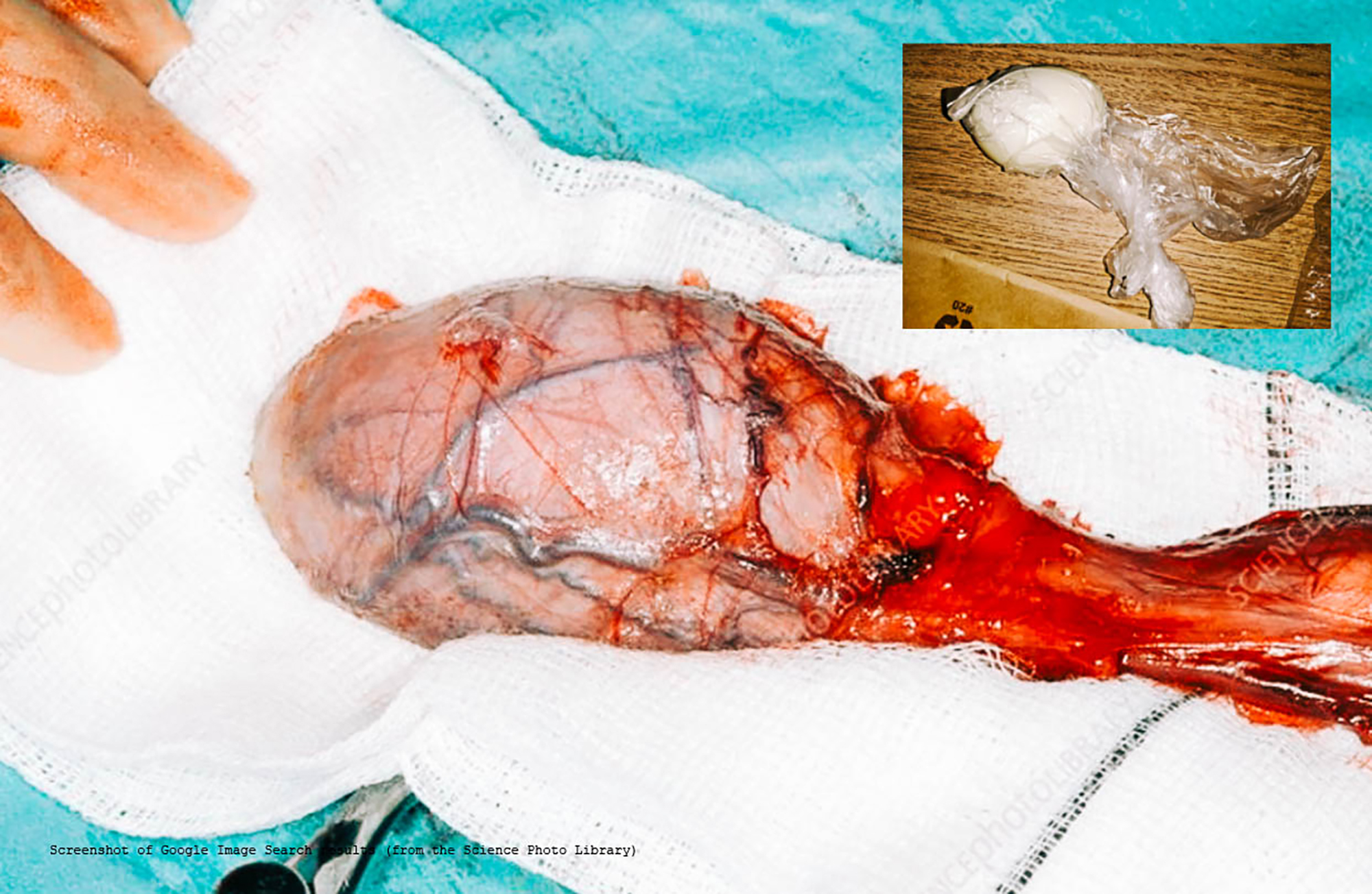 Radical orchiectomy: removal of a malignant testicle